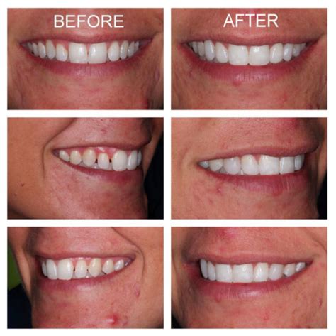 Composite Veneers (Pros, Cons & Cost.